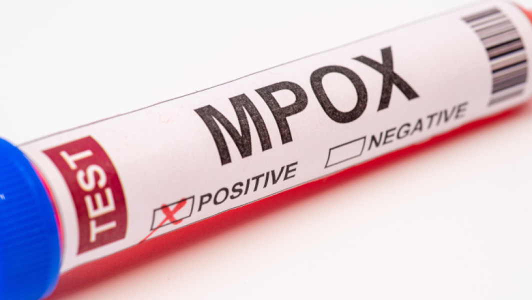 Un nou caz de mpox în Regatul Unit, fără legături de călătorie