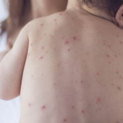 Incidenţa rujeolei în România a revenit la nivelul dinaintea vaccinării, avertizează pediatrul Mihai Craiu